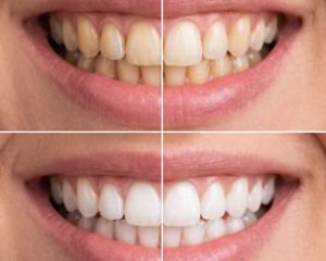Teeth Whitening