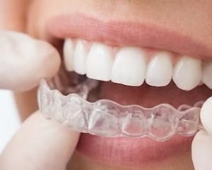 Invisalign
